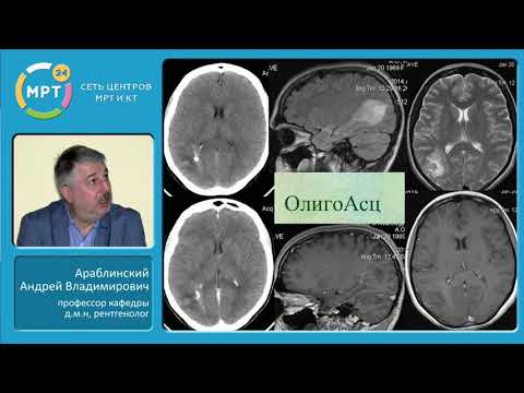 Диффдиагностика нарушений мозгового кровообращения