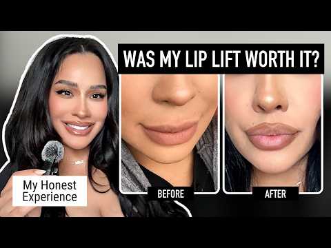 Was My Lip Lift Worth It? My Honest Experience