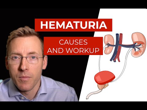 Hematuria: causes and evaluation of blood in your urine