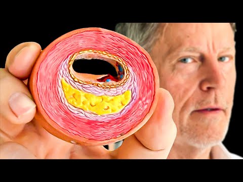 #1 Best Way to Find CLOGGED Arteries