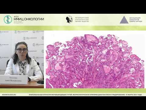 Папиллярные уротелиальные образования мочевыводящих путей (Хохлова А.В.)