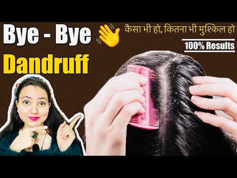 बालों का झड़ना, डैंड्रफ और खुजली को दूर करें in 1st Wash, Remove Dandruff Permanently | 100% Natural