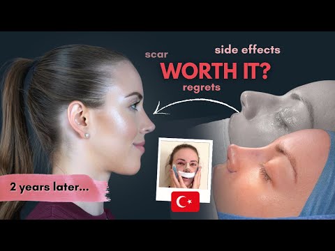 Turkey Rhinoplasty 2 Year Later: Post-op Nose Job Update — Was It Worth It?