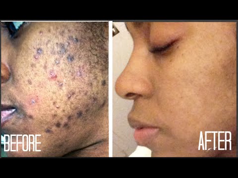 SKIN| How I Got Rid of Dark Scars (Hyperpigmentation) & Acne + GIVEAWAY!