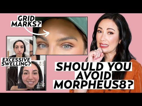Morpheus8 Treatment: Dermatologists Explain Radiofrequency Microneedling