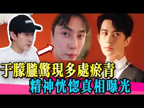 於朦朧臉部淤青驚現！黑暗真相讓人心痛！！！#于朦胧 #yumenglong #檀健次 #杨幂 #金星 #喬任梁 #真相 #娱乐圈 #於朦朧 #八卦 #追光吧哥哥  #tvb