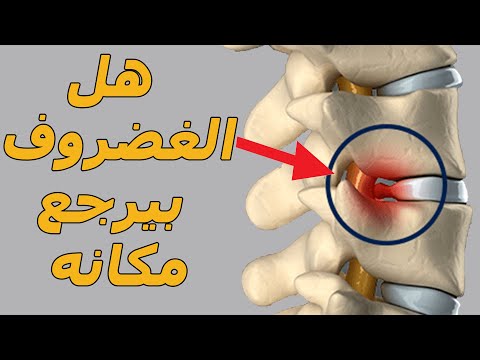 علاج انزلاق الغضروف وعرق النسا بدون جراحه/هل الغضروف بيرجع مكانه بدون عمليه جراحيه؟