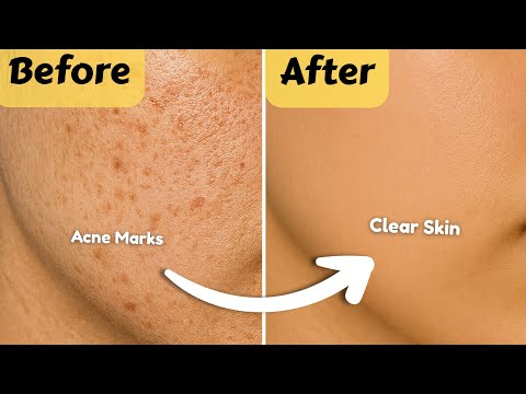 How to *ACTUALLY fade acne marks in weeks 🎀 || Spots / Scars ||