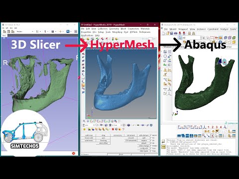 Mandible bone model from 3D Slicer to Abaqus with help of HyperMesh and MeshMixer