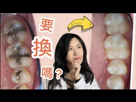 『有補牙的必看』不知道的人都後悔了！補牙可以撐多久？那個材質比較好？@DrTeresa