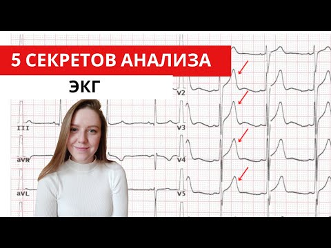 5 секретов анализа ЭКГ