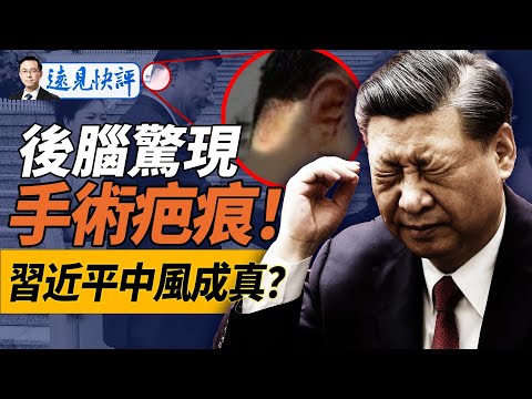 習近平怪異髮型洩密：後腦驚現手術疤痕？！可能性最大是這個手術！馬英九突稱“反共”；中共“接管台灣”預案曝光。｜遠見快評 唐靖遠 | 2024.08.21
