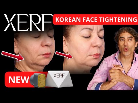 New Face Tightening Treatment- XERF