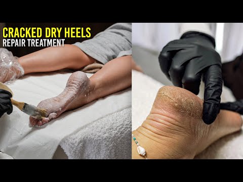Satisfying Hard Skin Removal & Relaxing Paraffin Wax Treatment 