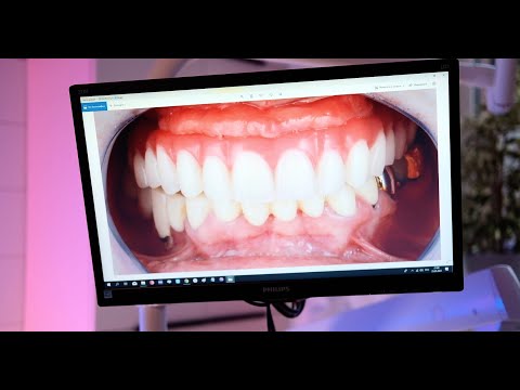 НЕ ДЕЛАЙТЕ ALL-ON-4 пока не посмотрите это видео!