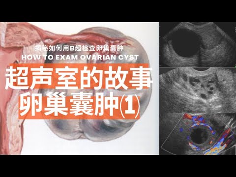 卵巢囊肿(1):为什么会得卵巢囊肿/常见生理性卵巢囊肿/症状有哪些/B超是如何检查的/囊肿出血和扭转/预防和治疗【Ultrasound Room】Ovarian Cyst (1)
