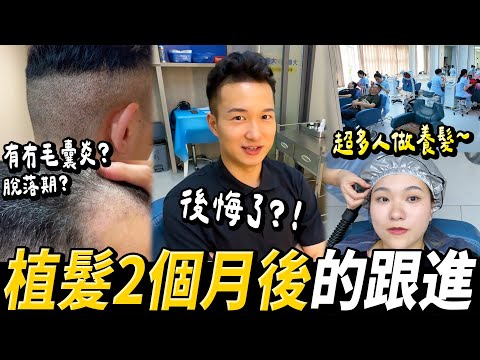 【北上植髮】後悔了😱？2個月疑似失敗😰毛囊炎？養髮療程唔洗植都得？#深圳植髮 #北上植髮 #植髮 #微針植髮