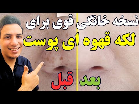 با این نسخه از شر لکه های قهوه ای پوست خلاص شو| درمان خانگی لکه های پوستی