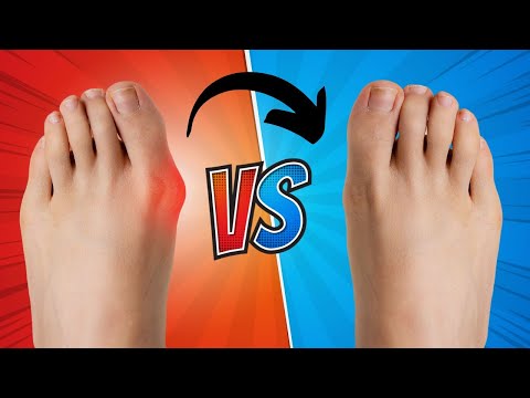How To Fix A Bunion In 5 Steps