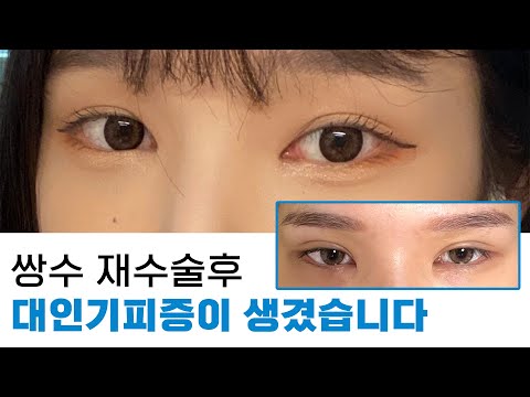 라인을 높이는 것보다 낮추는 것의 중요성(두줄따기,흉터,겹주름,라인 높이기,방법)