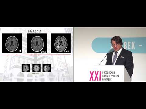 Лечение рецидивов глиобластомы