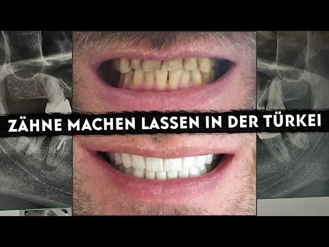 Zähne machen lassen in der Türkei