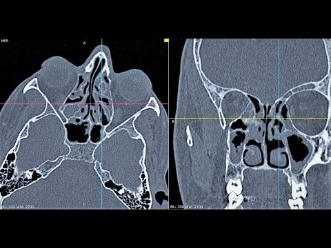 AXIAL CT PNS | HOW TO READ
