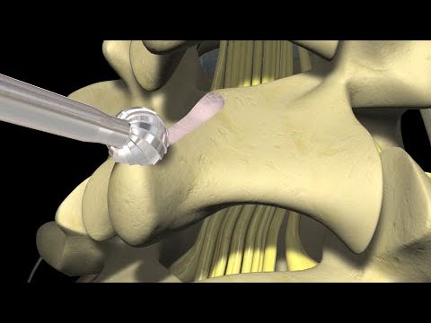 Low Back Pain: Lumbar Laminectomy Surgery