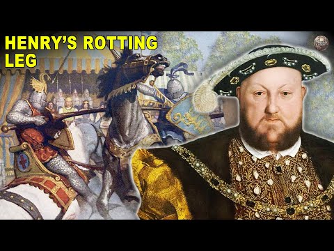 Everything You Didn't Need To Know About Henry VIII's Ulcerated Leg