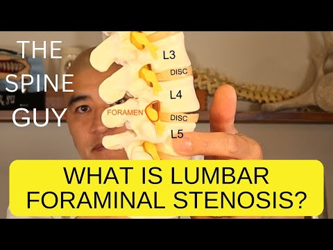 What is Lumbar Foraminal Stenosis?