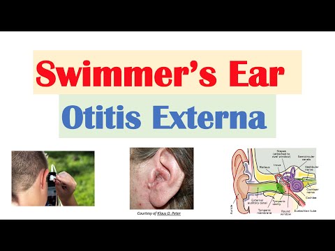 Swimmer’s Ear (Otitis Externa) | Risk Factors, Causes, Signs & Symptoms, Diagnosis, Treatment