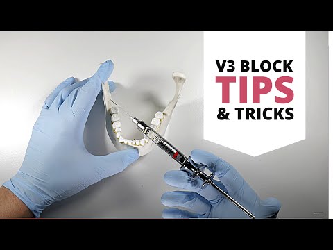 Why Your Mandibular V3 (IAN) Blocks Are Failing | OnlineExodontia.com