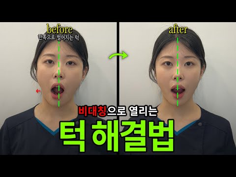 The Main Cause of Facial Asymmetry: How to Fix the "Zigzag" Opening of the Mouth