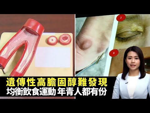 遺傳性高膽固醇難發現 均衡飲食運動、年青人都有份 醫生分析症狀及潛在風險 -TVB最強生命線 -香港新聞 -TVB News -黃靖婷