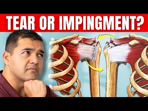 Is Your Shoulder Pain a Rotator Cuff Tear or Impingement? (How to Tell)
