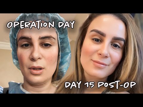 Day 1 through 15 Eyebrow Hair Transplant progression | Part 3