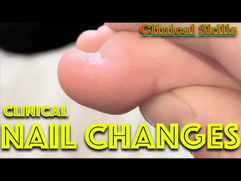 Clinical Nail Changes - Nail Signs Suggesting Disease - Dr Gill