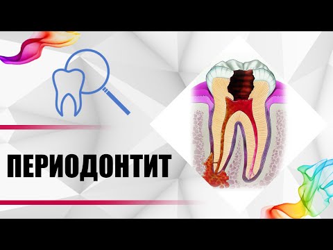 Периодонтит - лечение каналов зуба за 7 шагов без боли. [ Диагностика, симптомы, последствия ].