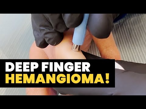 DEEP FINGER HEMANGIOMA!