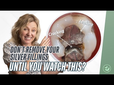 Exposing the Truth About Mercury Fillings (And What Your Dentist Won’t Tell You)