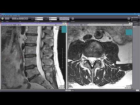 How to Read Your MRI with Onis 2.5 - part 2 of 2 (Advanced Lumbar Spine MRI Anatomy)