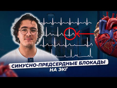 Синусно-предсердные блокады на ЭКГ (CА-блокады)