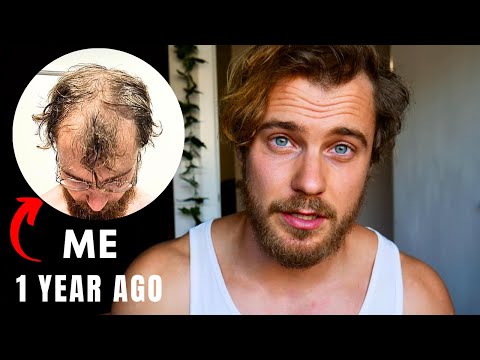 Preventing Balding: What I Did Before It Was Too Late.