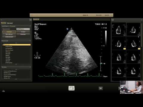 Вебинар «Исследование деформации миокарда в клинической практике» (запись мастер-класса 30.11.17)