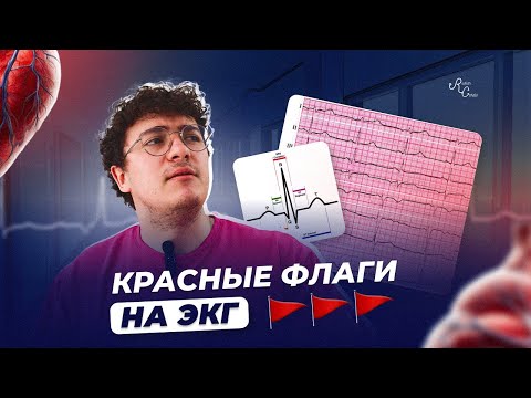 Красные флаги на ЭКГ. Что нельзя пропустить?