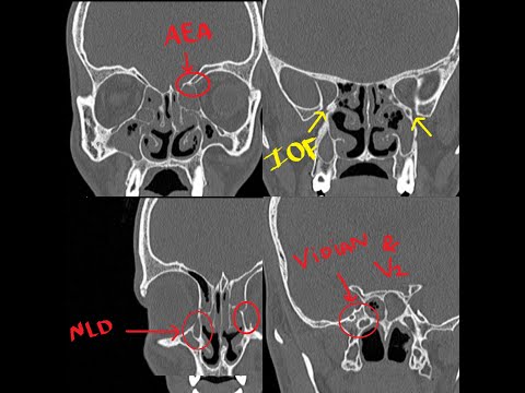 E.N.T PRACTICAL EXAM VIVA /SPOTTERS. Questions asked in VIVA exam.HOW to read a CT SCAN PNS.