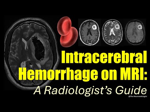 Intracerebral Hemorrhage on MRI: a step-by-step guide for radiologists.