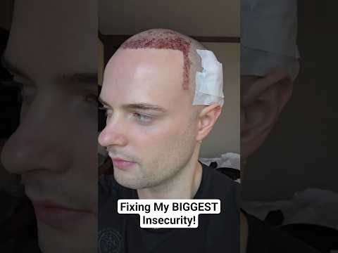 I Got a Hair Transplant in Istanbul Turkey! @SmileHairClinic