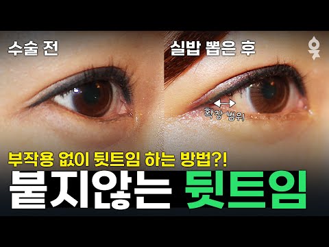 붙지않는 3D 뒤트임! 부작용❌ 뒤트임하는 방법