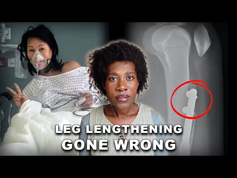 She Went to Lengthen Her Limbs But Ended Up With Broken Bones | Case of Elaine Foo